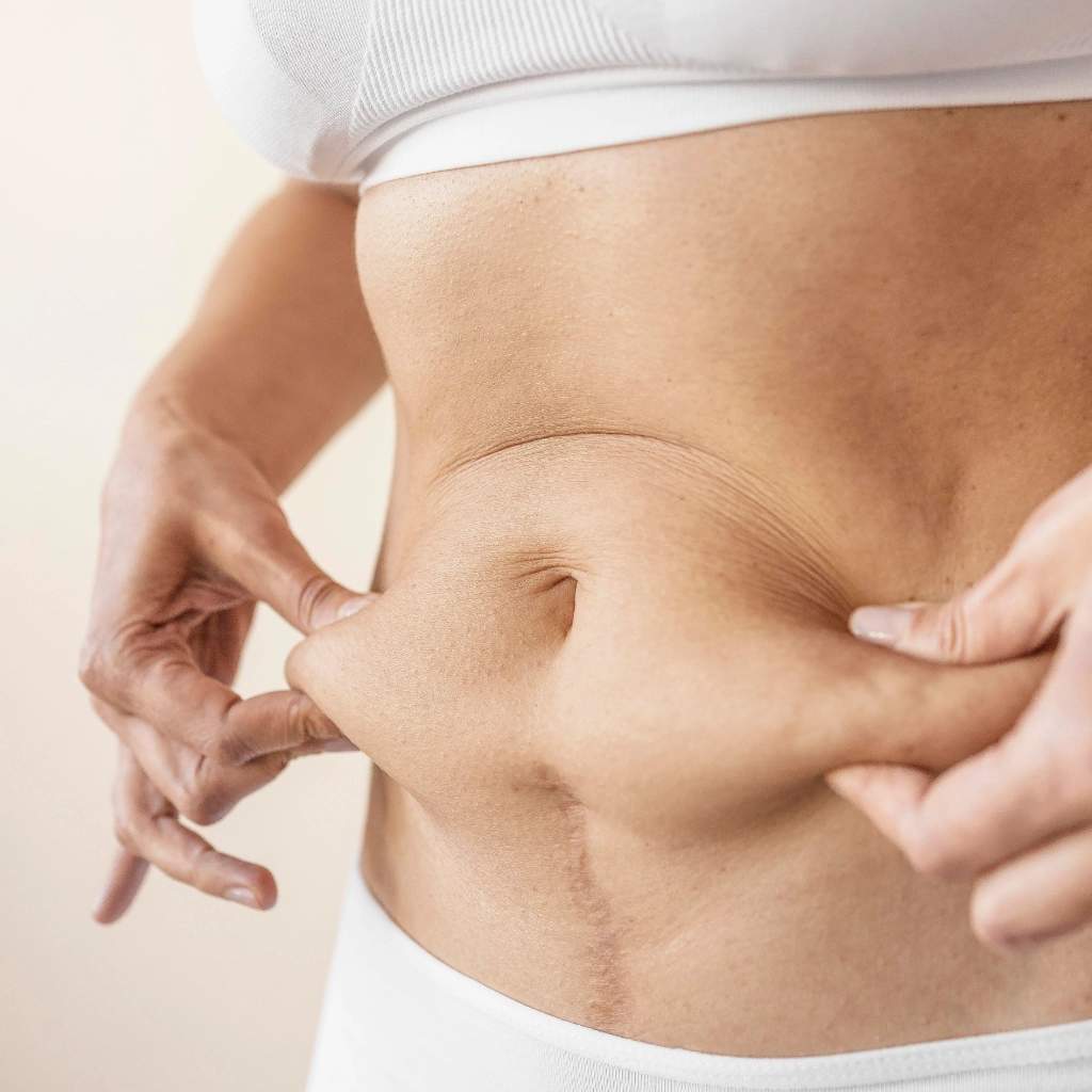 Mujer mostrando diástasis abdominal tratada con fisioterapia estética enfocada en la recuperación de la faja abdominal y la firmeza del tejido.